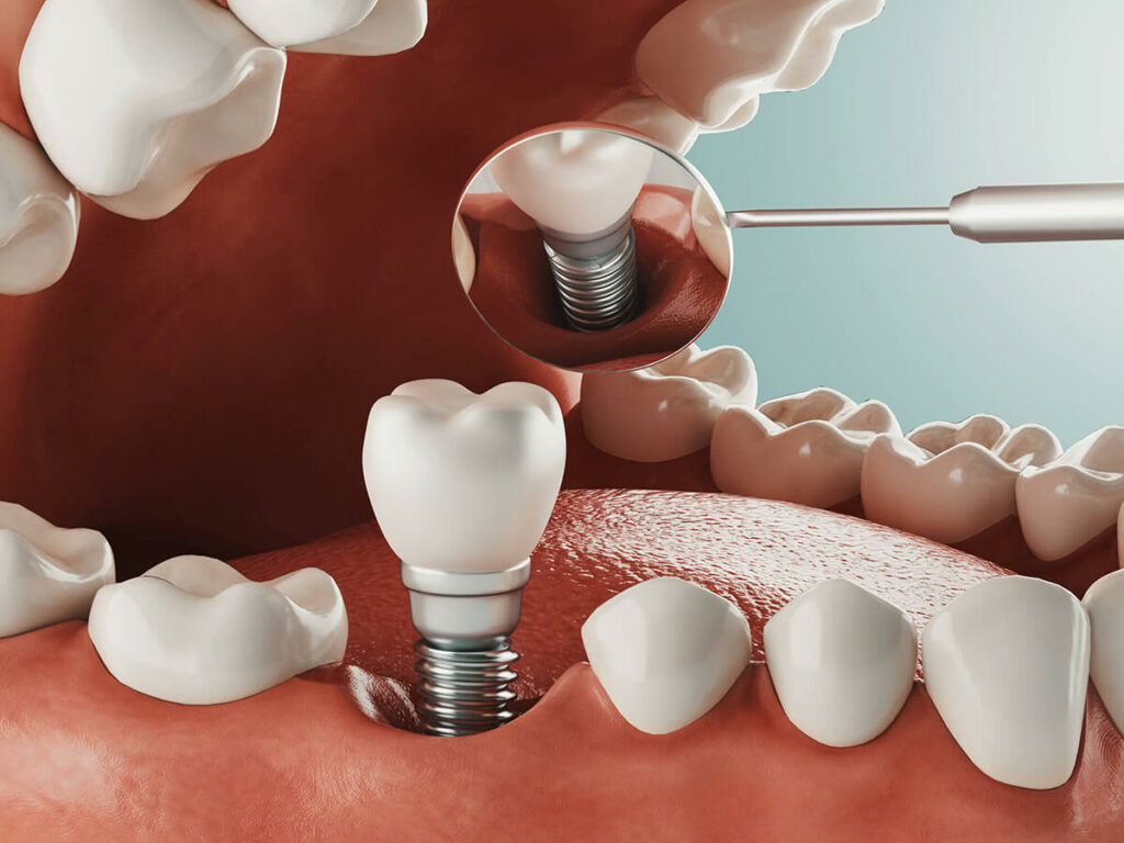 visual mockup of a bottom getting a dental implant