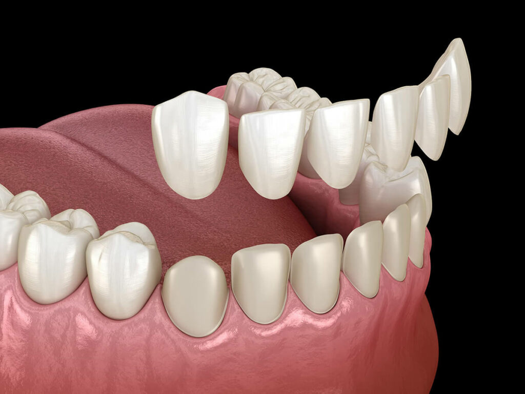 visual of a bottom row of teeth getting dental veneers