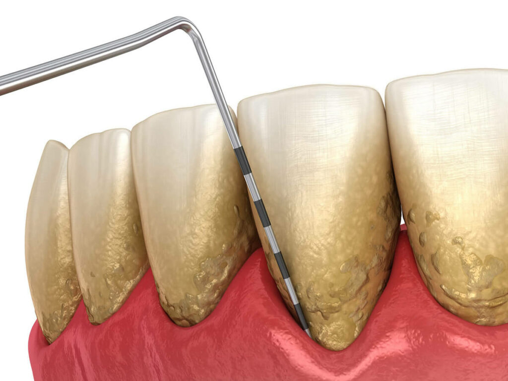 visual mockup of a bottom row of teth suffering from gum disease