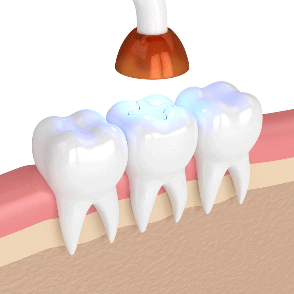 three teeth a bottom row with the middle one receiving a filling