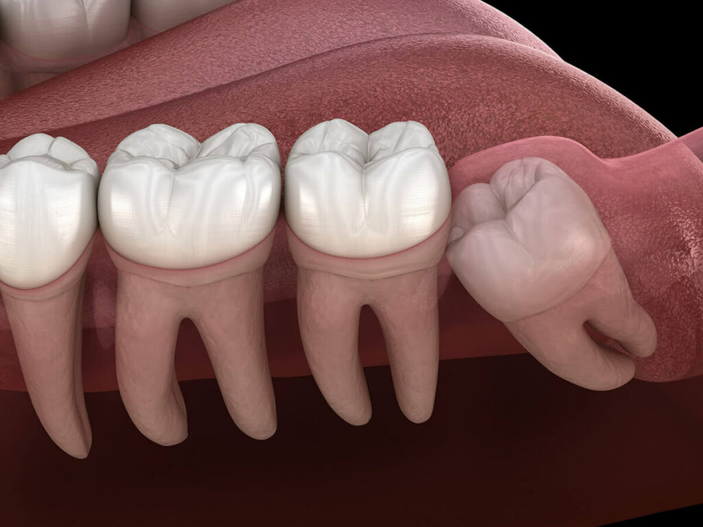 bottom row of teeth with a impacted wisdom tooth