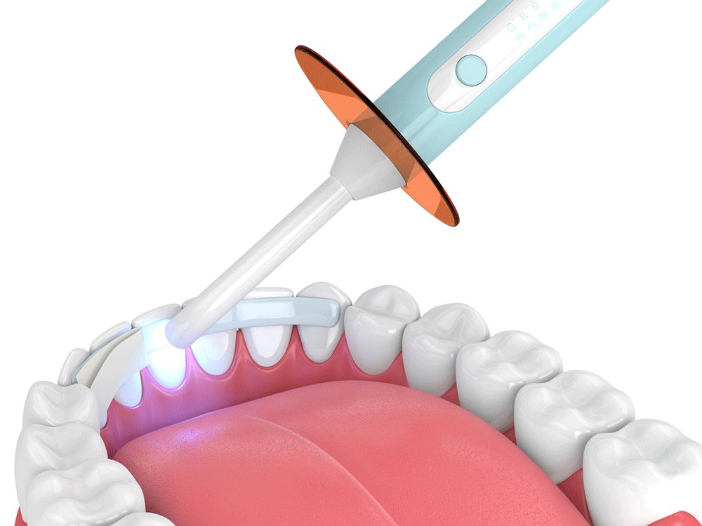 visual of a bottom row of teeth receiving dental bonding