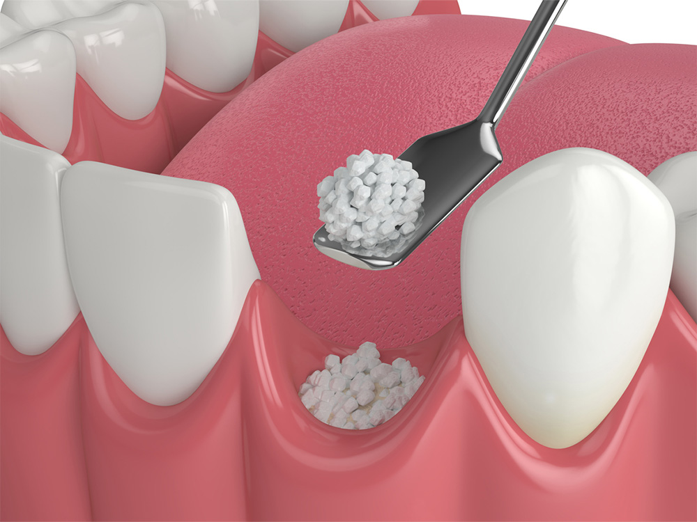 bottom row of teeth receiving dental bone grafting where there is a missing tooth