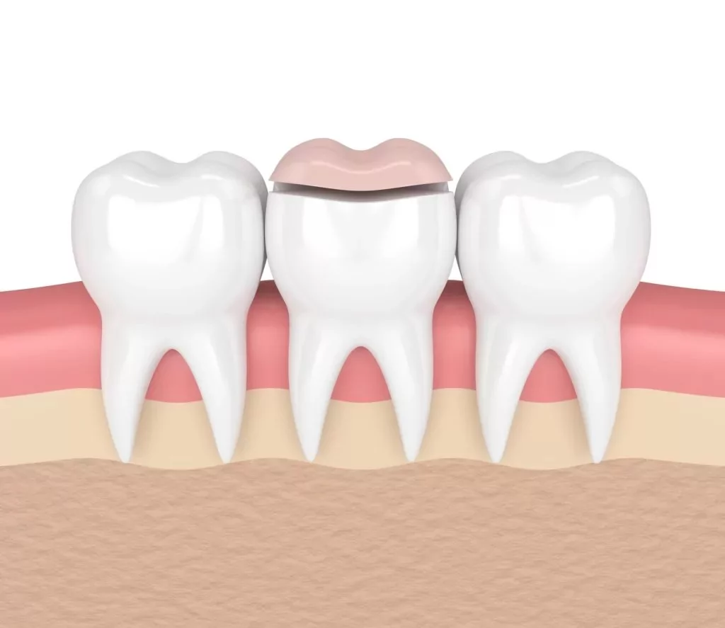three bottom teeth with the middle tooth getting an onlay