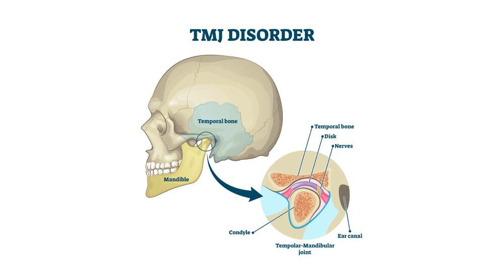 TMJ disorder vector illustration. Labeled jaw condition educational scheme.