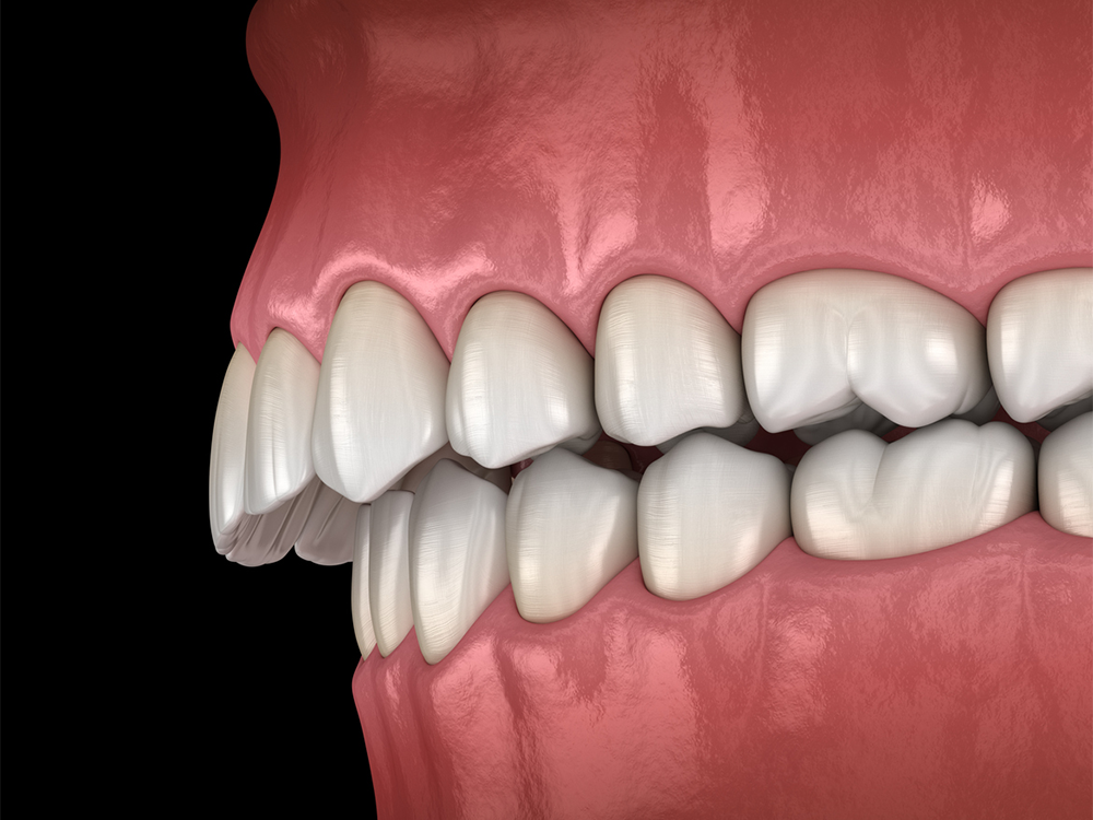 visual mockup of a set of teeth suffering from an overbite