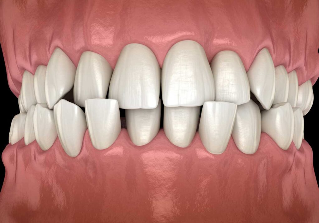 visual mockup of a set of teeth suffering from a crossbite