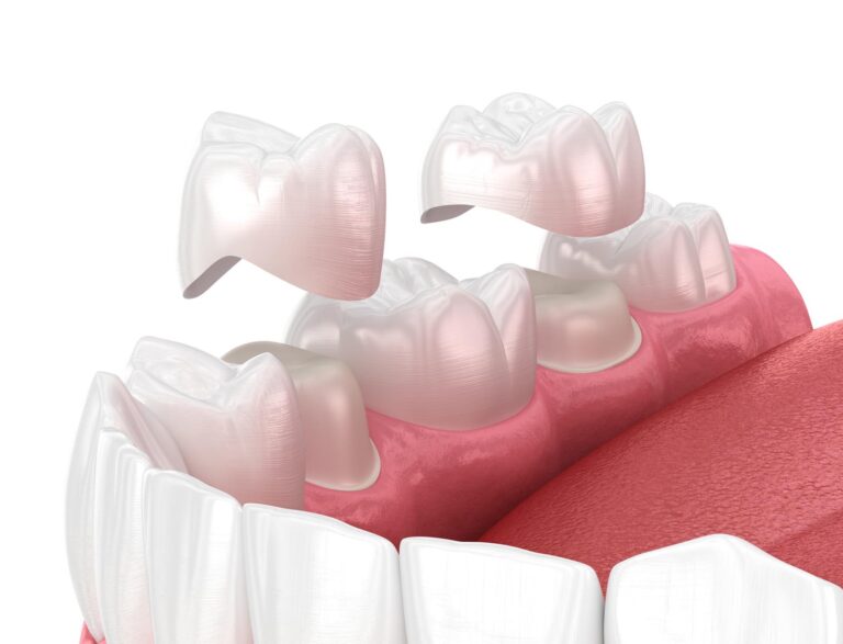 A close-up view inside the mouth shows dental crowns being placed onto prepared teeth, illustrating a restorative procedure. The image highlights precision in positioning and the aesthetic goal of replicating natural tooth appearance.