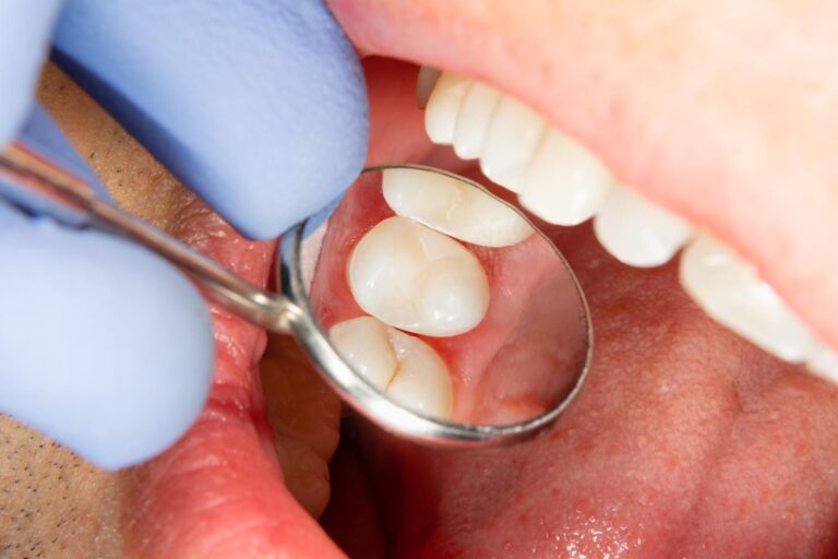 A dentist uses a dental mirror and instrument to examine the back teeth inside a patient’s mouth. The gums and molars are clearly visible during a close up oral examination.